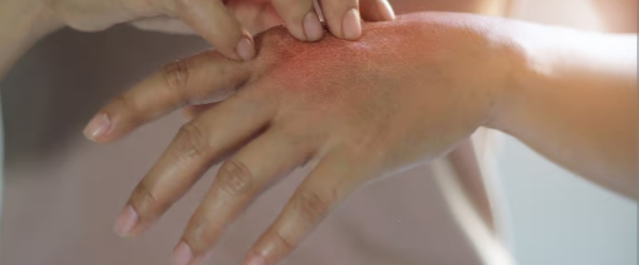 Jak walczyć z grzybicą skóry? 